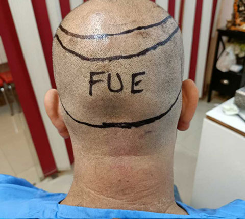 Back view of a patient's head who is about to undergo FUE hair transplant procedure by Dr. Poonam Arya, displaying areas from where donor hair will be taken with the help of markings