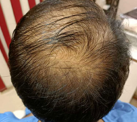 Back view of a balding male patient's head