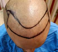 Balding male patient in his 30s with markings on his shaved scalp for the preparation of the FUE hair transplant procedure being done by Dr. Poonam Arya