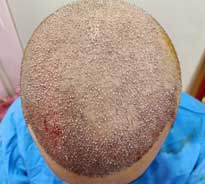 Top down view of the scalp of man who just underwent FUE hair transplant procedure done by Dr. Poonam Arya, displayings areas where donor hair has been grafted